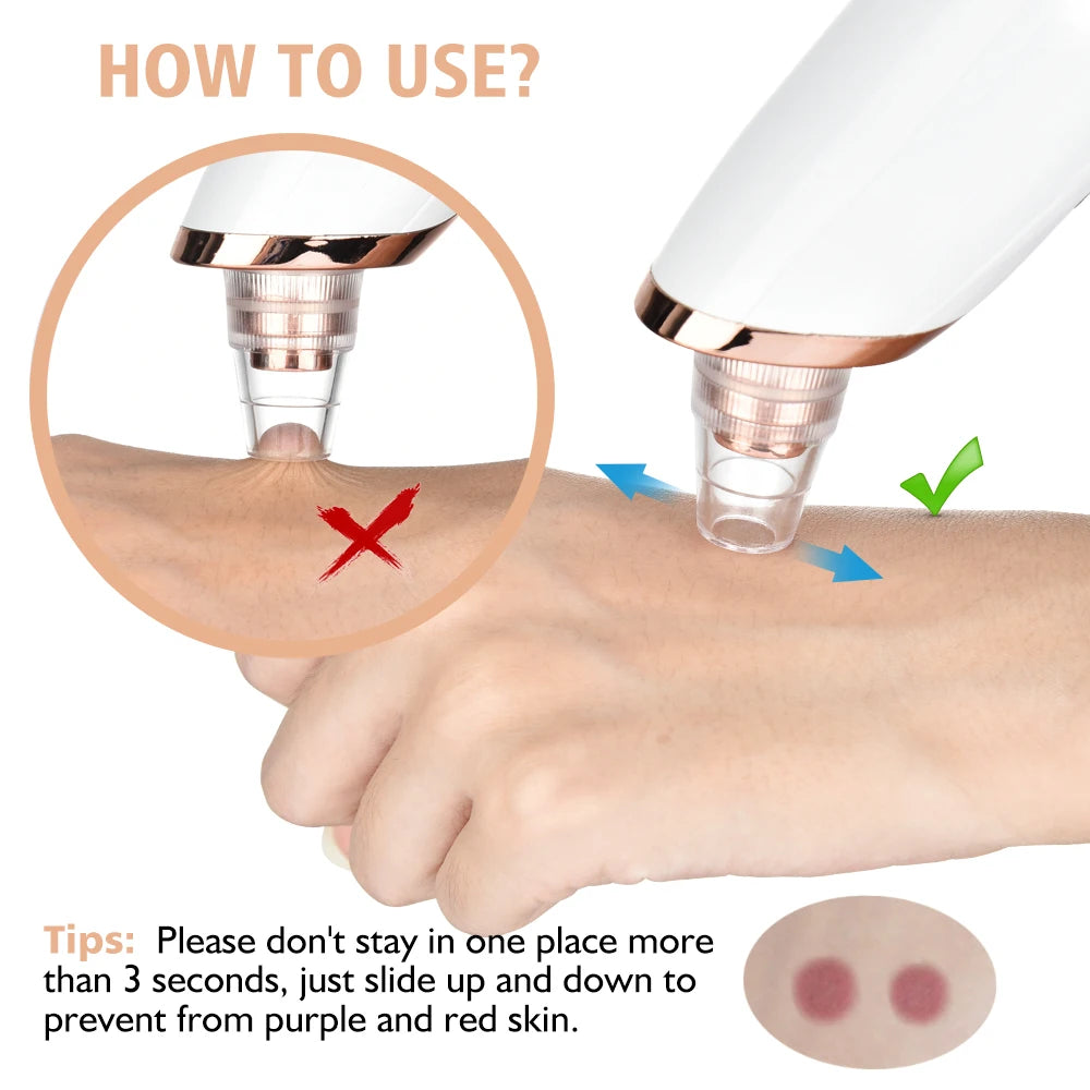 Marbendi Electric Blackhead Remover for Clear Skin Care