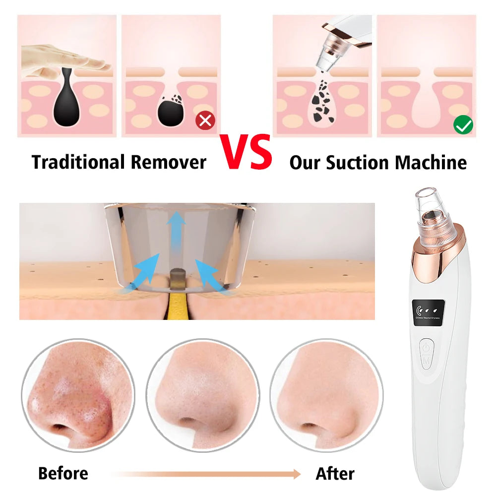 Marbendi Electric Blackhead Remover for Clear Skin Care